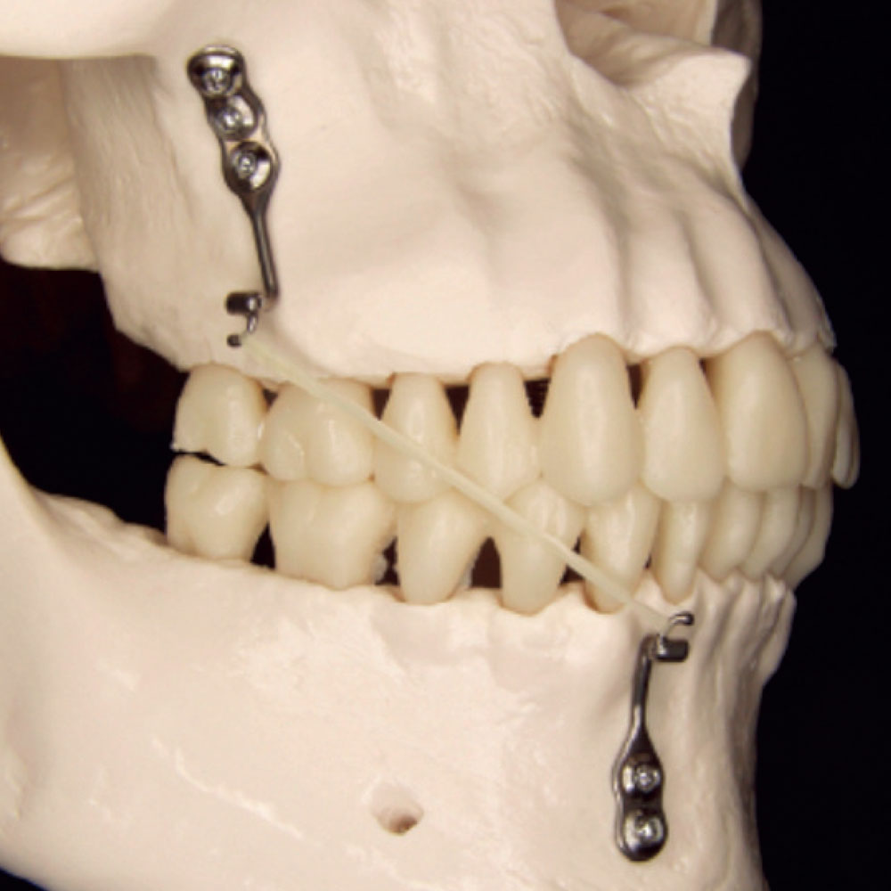 โครงการวิจัยและพัฒนา Bone-Anchored Maxillary Protraction (BAMP)