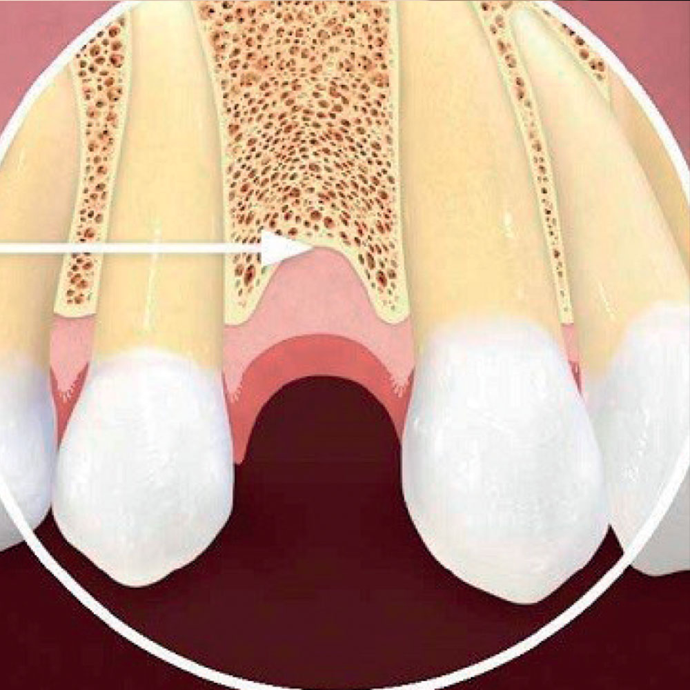 โครงการวิจัยและพัฒนา กระดูกเทียม (Bone Filler)